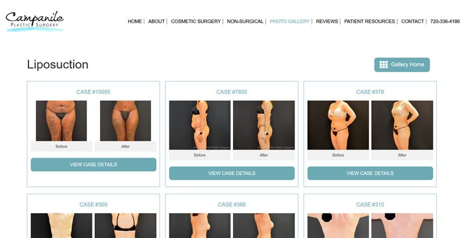 Live before-and-after gallery at Campanile Plastic Surgery